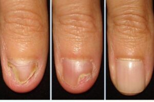 Acabe com a Micose de Unha de uma Vez