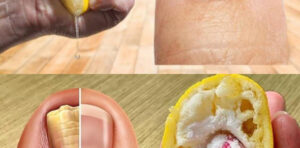 Fungos nas unhas: um tratamento 100% natural contra fungos nas unhas dos pés e mãos