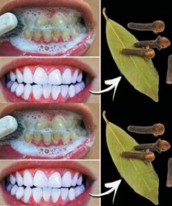 Remova o tártaro e clareie os dentes naturalmente em poucos minutos…