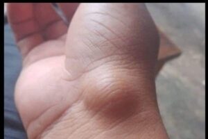 Esse Caroço na Pele Pode Surgir Por Causa de Uma Coisa