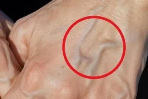 Preste atenção: isso é o que significa se você tem veias visíveis e saltadas – Receita Rápido