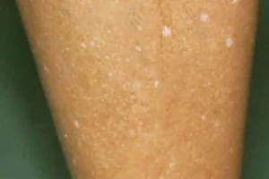 Manchas Brancas na Pele? A ‘Receita’ Nutritiva que Sua Pele Precisa: Smoothie Revitalizante com Vitaminas D, B12 e Zinco!