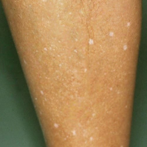 Manchas Brancas na Pele: Causas Comuns e Quando se Preocupar – Museu de Sabores