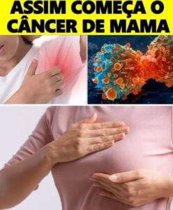 É assim que o câncer de mama começa e ninguém toma cuidado