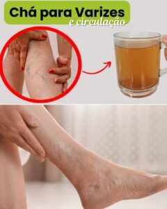 Chá para Varizes e Má Circulação: Receita Natural para Ajudar na Saúde das Pernas