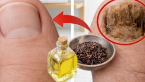 Óleo Natural de Cravo-da-Índia Para Unhas com Fungos: A Misturinha Caseira Que Muita Gente Está Usando Para Cuidar dos Pés em Casa