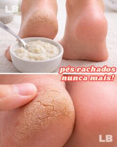 Misturinha para Eliminar Rachaduras nos Pés: Receita Caseira Simples e Eficiente